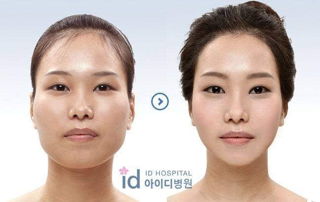 เผยภาพ 20 ภาพสาวเกาหลี ก่อน-หลัง ทำศัลยกรรม เหมือนได้ชีวิตใหม่เลย (14)