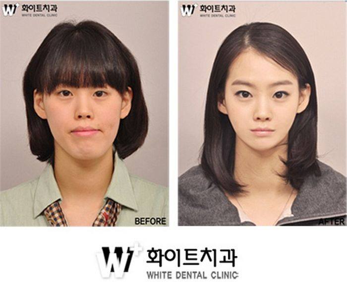 เผยภาพ 20 ภาพสาวเกาหลี ก่อน-หลัง ทำศัลยกรรม เหมือนได้ชีวิตใหม่เลย (15)