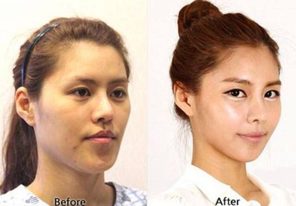 เผยภาพ 20 ภาพสาวเกาหลี ก่อน-หลัง ทำศัลยกรรม เหมือนได้ชีวิตใหม่เลย (16)