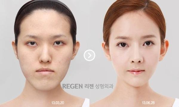 เผยภาพ 20 ภาพสาวเกาหลี ก่อน-หลัง ทำศัลยกรรม เหมือนได้ชีวิตใหม่เลย (19)