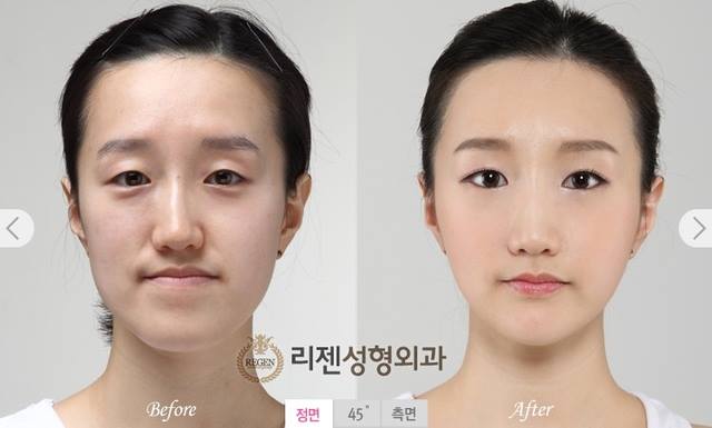 เผยภาพ 20 ภาพสาวเกาหลี ก่อน-หลัง ทำศัลยกรรม เหมือนได้ชีวิตใหม่เลย (20)