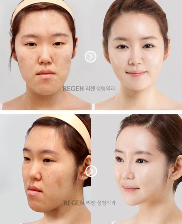 เผยภาพ 20 ภาพสาวเกาหลี ก่อน-หลัง ทำศัลยกรรม เหมือนได้ชีวิตใหม่เลย (21)