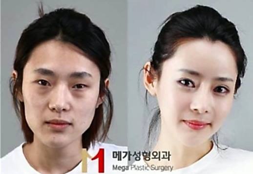 เผยภาพ 20 ภาพสาวเกาหลี ก่อน-หลัง ทำศัลยกรรม เหมือนได้ชีวิตใหม่เลย (22)