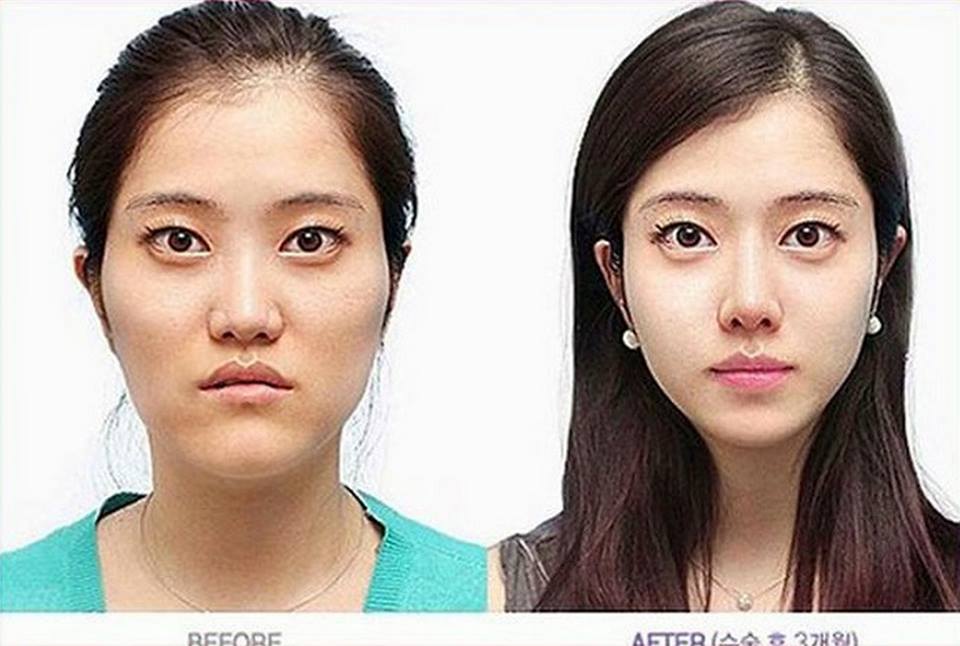 เผยภาพ 20 ภาพสาวเกาหลี ก่อน-หลัง ทำศัลยกรรม เหมือนได้ชีวิตใหม่เลย (23)