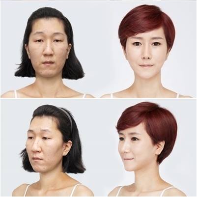เผยภาพ 20 ภาพสาวเกาหลี ก่อน-หลัง ทำศัลยกรรม เหมือนได้ชีวิตใหม่เลย (24)