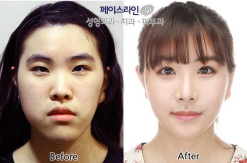 เผยภาพ 20 ภาพสาวเกาหลี ก่อน-หลัง ทำศัลยกรรม เหมือนได้ชีวิตใหม่เลย (25)