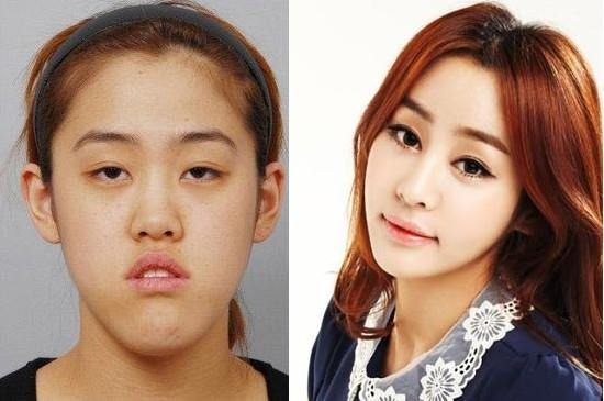 เผยภาพ 20 ภาพสาวเกาหลี ก่อน-หลัง ทำศัลยกรรม เหมือนได้ชีวิตใหม่เลย (6)