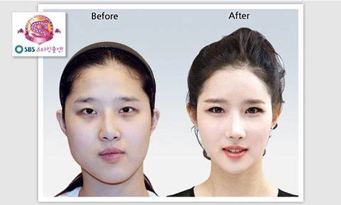 เผยภาพ 20 ภาพสาวเกาหลี ก่อน-หลัง ทำศัลยกรรม เหมือนได้ชีวิตใหม่เลย (7)
