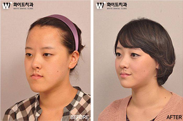 เผยภาพ 20 ภาพสาวเกาหลี ก่อน-หลัง ทำศัลยกรรม เหมือนได้ชีวิตใหม่เลย (9)